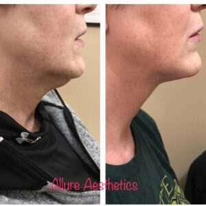 Kybella image