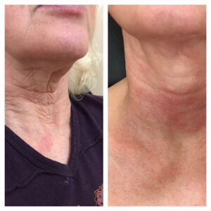 RX neck peel