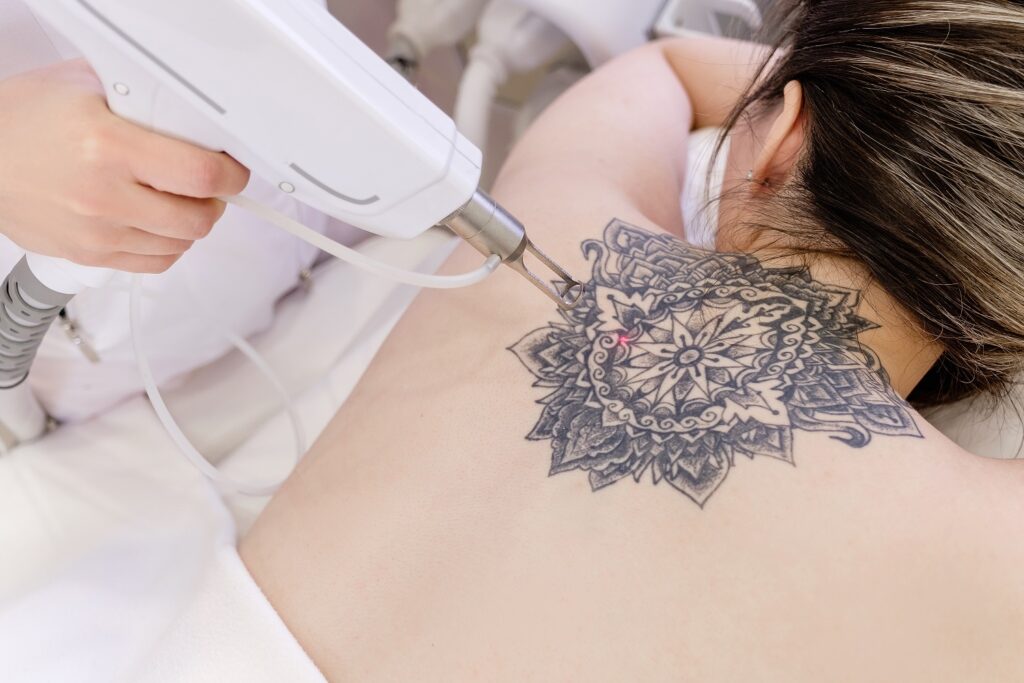 Laser Tattoo Removal in Great Falls, MT