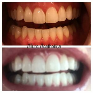 teeth-whitening-great-falls-mt