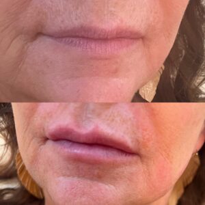 Lip Filler-after-before-eight-image-in-great-falls-mt