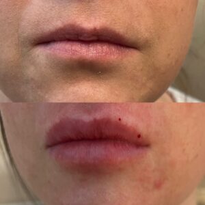 Lip Filler-after-before-eightteen-image-in-great-falls-mt