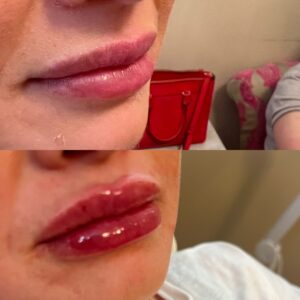 Lip Filler-after-before-eleven-image-in-great-falls-mt