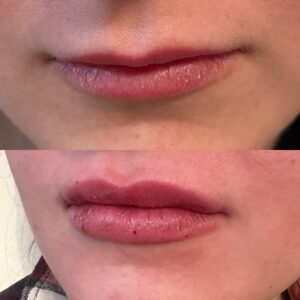 Lip Filler-after-before-fifteen-image-in-great-falls-mt