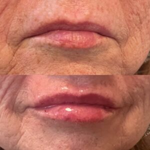 Lip Filler-after-before-five-image-in-great-falls-mt