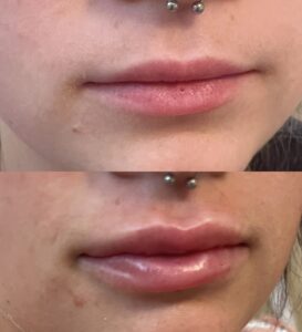 Lip Filler-after-before-four-image-in-great-falls-mt