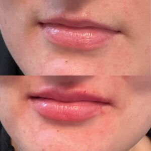 Lip Filler-after-before-fourteen-image-in-great-falls-mt