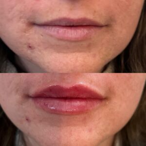 Lip Filler-after-before-nine-image-in-great-falls-mt