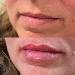 Lip Filler-after-before-one-image-in-great-falls-mt