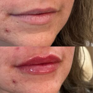 Lip Filler-after-before-seven-image-in-great-falls-mt