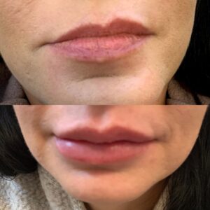 Lip Filler-after-before-seventeen-image-in-great-falls-mt