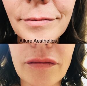 Lip Filler-after-before-ten-image-in-great-falls-mt