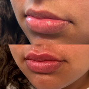 Lip Filler-after-before-thirteen-image-in-great-falls-mt