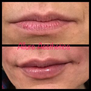 Lip Filler-after-before-three-image-in-great-falls-mt