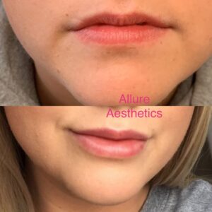 Lip Filler-after-before-twelve-image-in-great-falls-mt