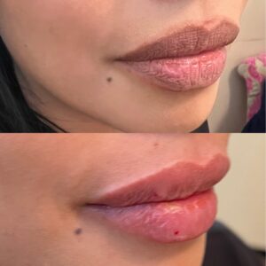 Lip Filler-after-before-twenty-five-image-in-great-falls-mt