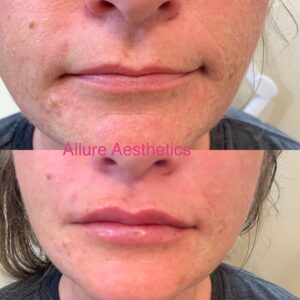 Lip Filler-after-before-twenty-four-image-in-great-falls-mt