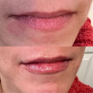 Lip Filler-after-before-twenty-one-image-in-great-falls-mt