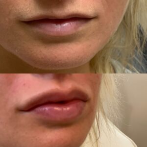 Lip Filler-after-before-twenty-three-image-in-great-falls-mt