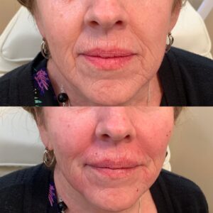 Lip Filler-after-before-twenty-two-image-in-great-falls-mt