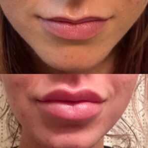 Lip Filler-after-before-two-image-in-great-falls-mt