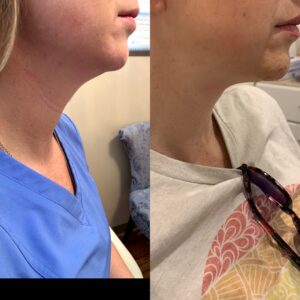 kybella-after-before-eight