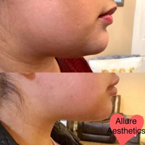 kybella-after-before-one