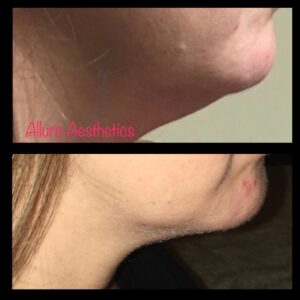 kybella-after-before-six