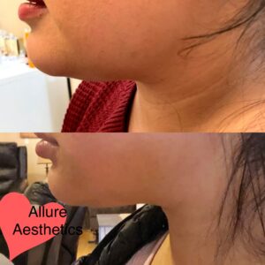 kybella-after-before-three