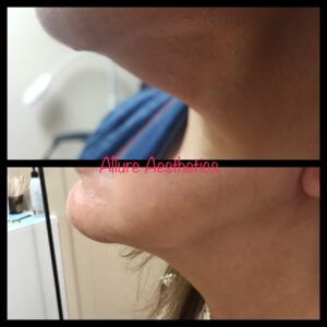 kybella-after-before-two