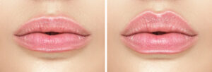 cosmetic fillers