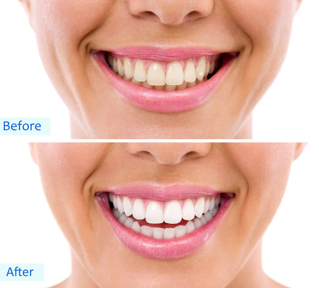 teeth whitening