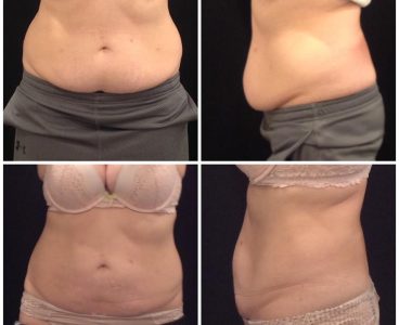 CoolSculpting after before