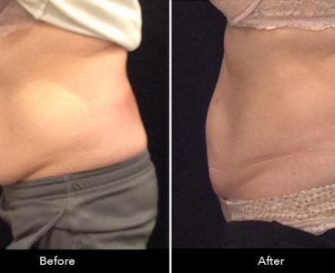 cool-sculpting-before-and-after