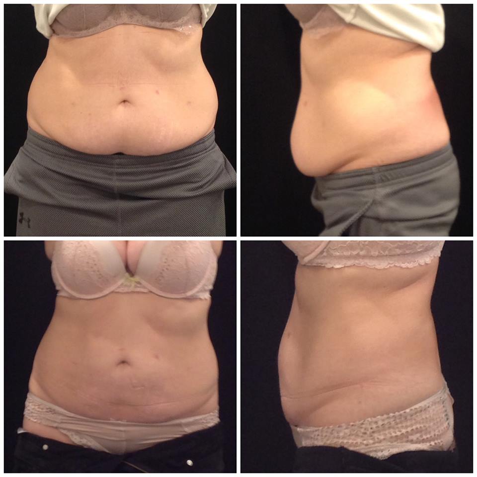 CoolSculpting after before