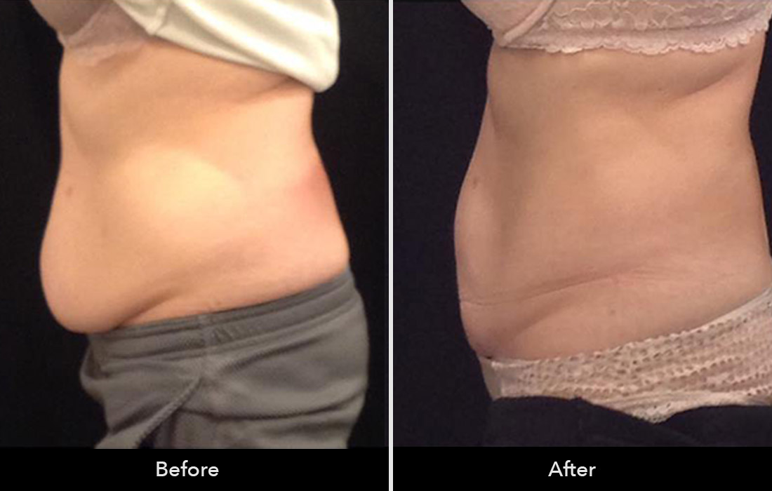 cool-sculpting-before-and-after