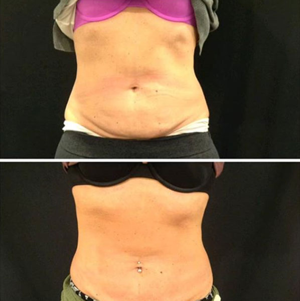 cool-sculpting-1
