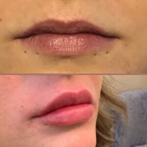 Lip Filler-after-before-nineteen-image-in-great-falls-mt