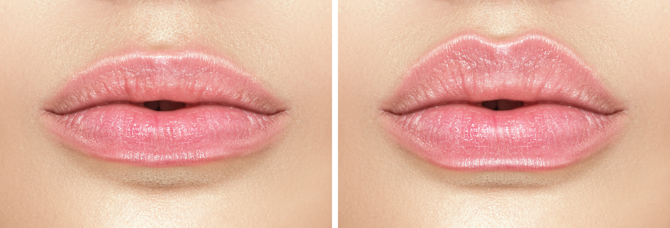 Before and after lip filler injections by Allure Aesthetics